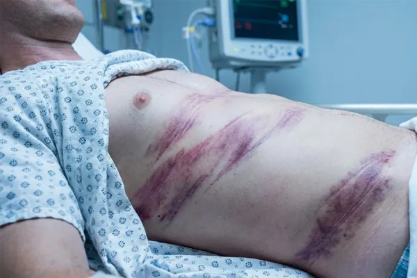 SThe (Seatbelt Sign)—diagonal bruising indicating severe blunt force trauma and potential internal organ damage.